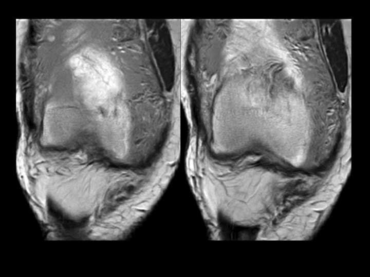 Figure 3 for case Lipoma Arborescens